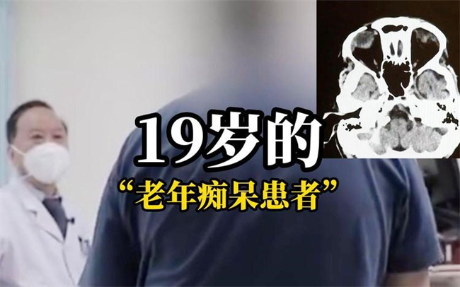 发现19岁阿尔兹海默症患者 目前是最年轻患者