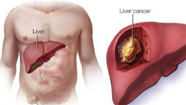 肝癌为什么会悄悄来袭 肝癌身体发出哪3大预警信号