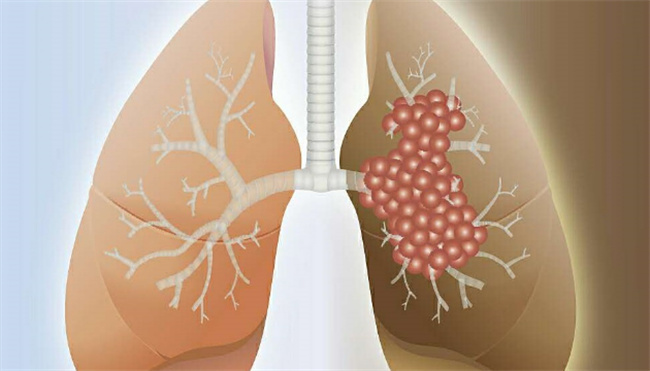 肺癌的早期症状有什么 肺癌形成的病因是什么