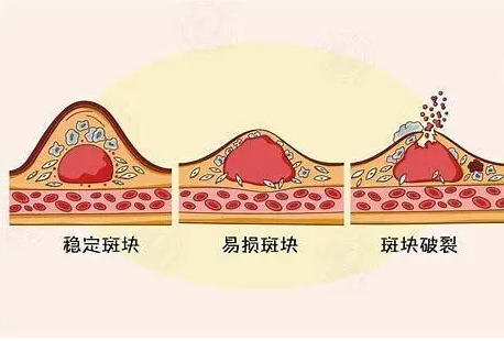 人与血管同寿！善用“血管清道夫”，畅通血管护心脑，血管比您更年轻！