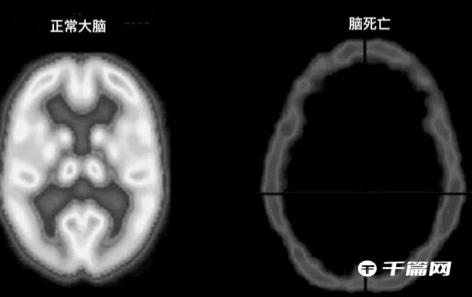 正常大脑与脑死亡有什么区别