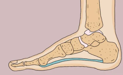 扁平足走路脚掌痛怎么办