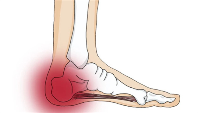 脚后跟痛的主要原因是什么 脚后跟痛要怎么治疗