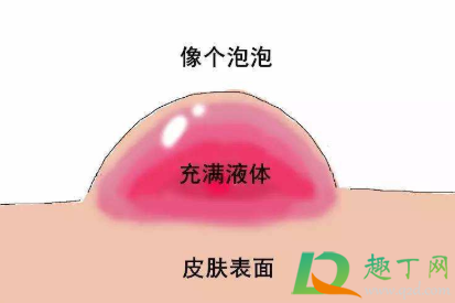 水泡怎么处理不痛