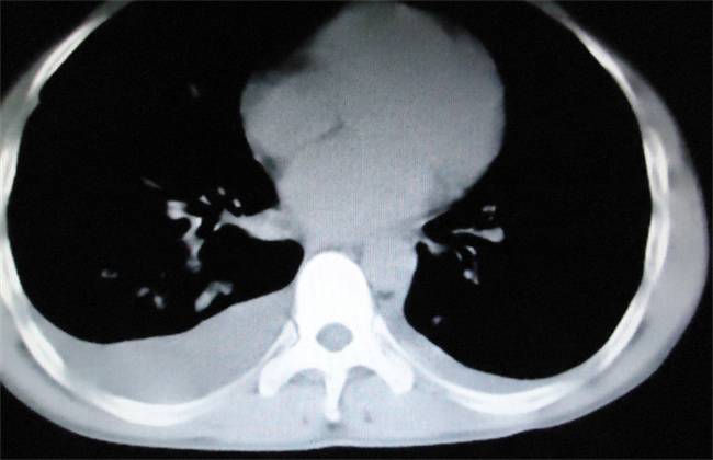 哪些情况需要做肺部CT