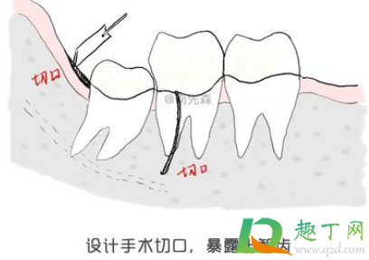 智齿横着长了拔掉难度大吗