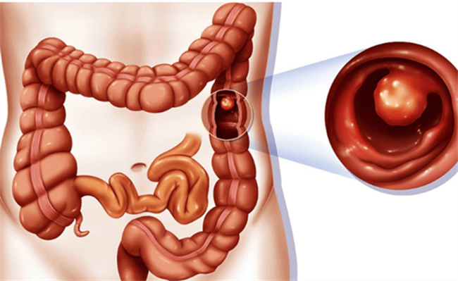 哪八类长期腹泻的人 可能患有肠癌？