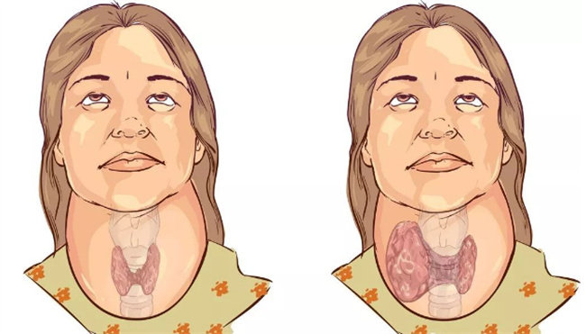 ​甲状腺肿大可以吃海盐吗 甲状腺肿大可以吃海参吗