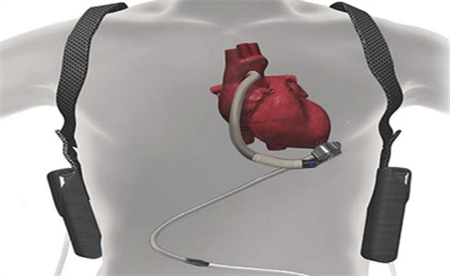 全国首例心脏不停跳人工心脏植入 表明了什么？